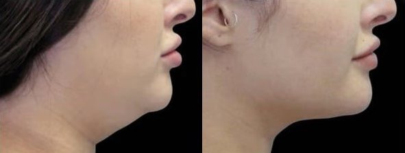 Before and After Photo by Perfect Med SPA in New York New York