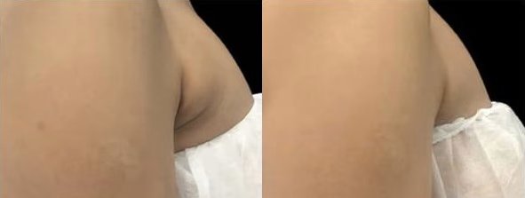 Before and After Photo by Perfect Med SPA in New York New York