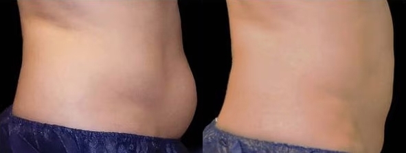 Before and After Photo by Perfect Med SPA in New York New York