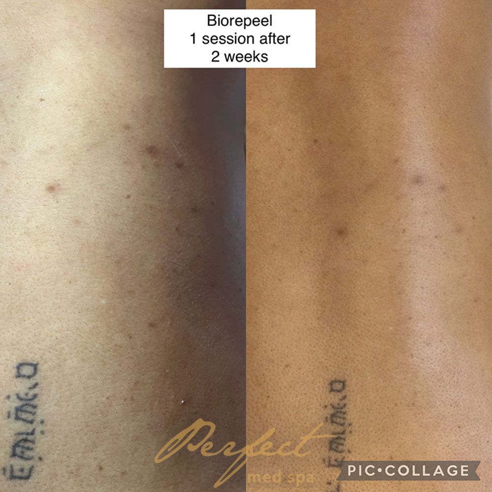 Chemical Peel Before and After Photo by Perfect Med SPA in New York New York