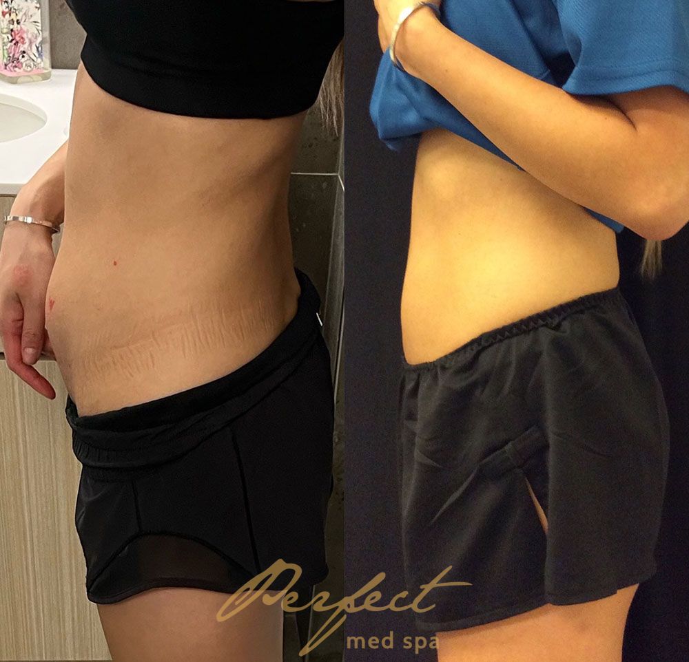 CoolSculpting Before and After Photo by Perfect Med SPA in New York New York
