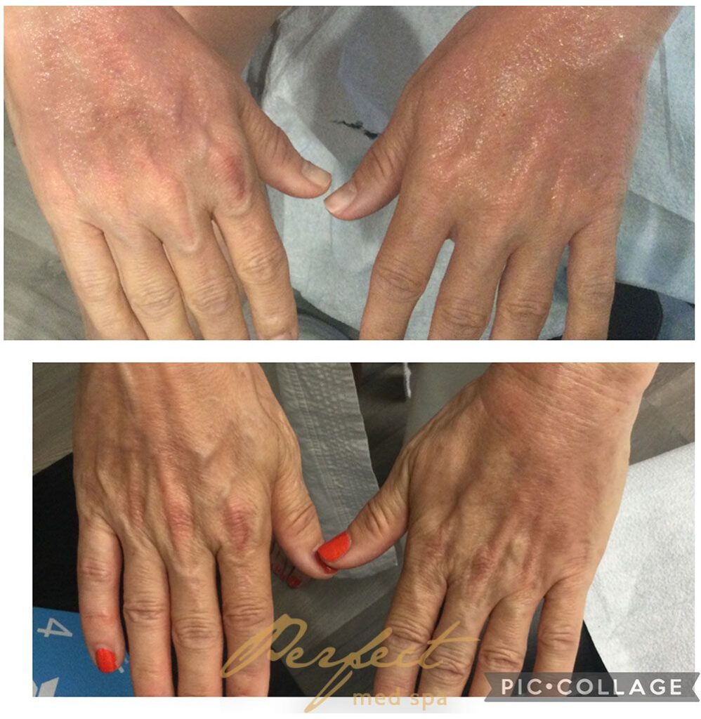 Hand Rejuvenation Before and After Photo by Perfect Med SPA in New York New York