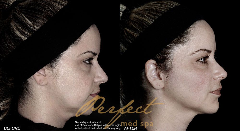 Jawline contouring injections Before and After Photo by Perfect Med SPA in New York New York