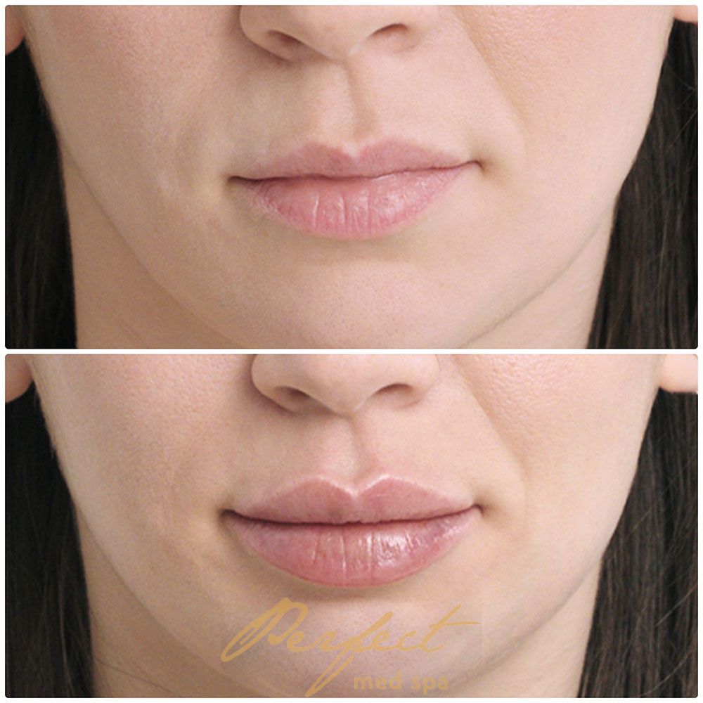 Lips Injections Before and After Photo by Perfect Med SPA in New York New York