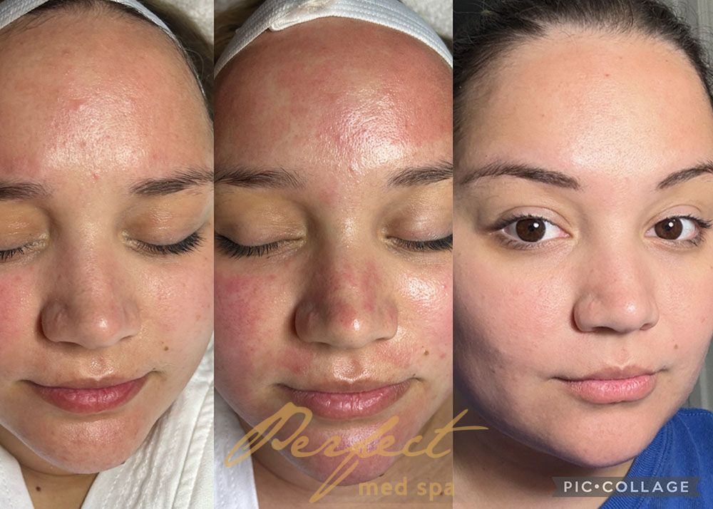 Microneedling Before and After Photo by Perfect Med SPA in New York New York