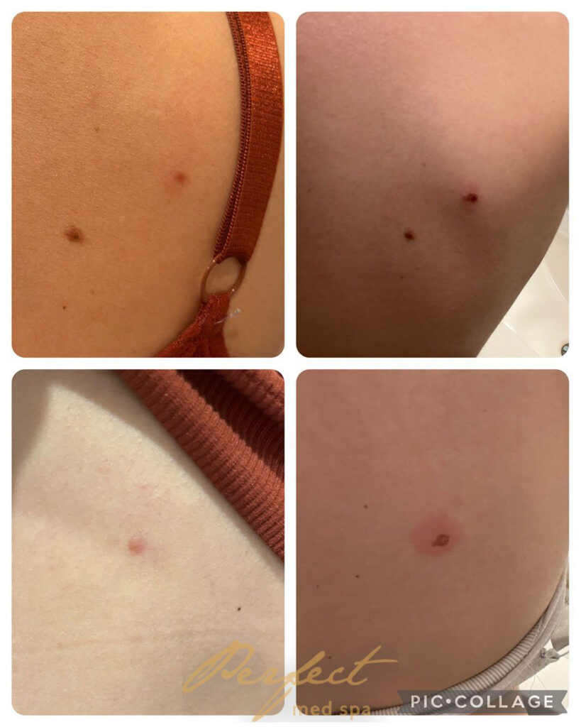 Mole Removal Before and After Photo by Perfect Med SPA in New York New York