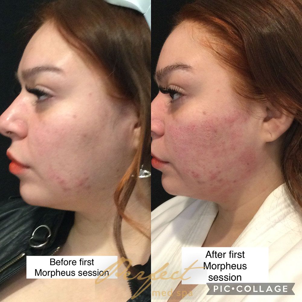 Morpheus8 Before and After Photo by Perfect Med SPA in New York New York