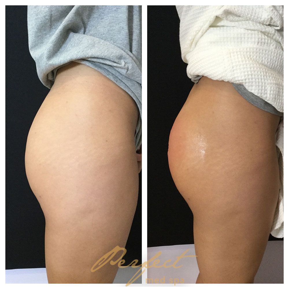 Sculptra for buttocks augmentation Before and After Photo by Perfect Med SPA in New York New York