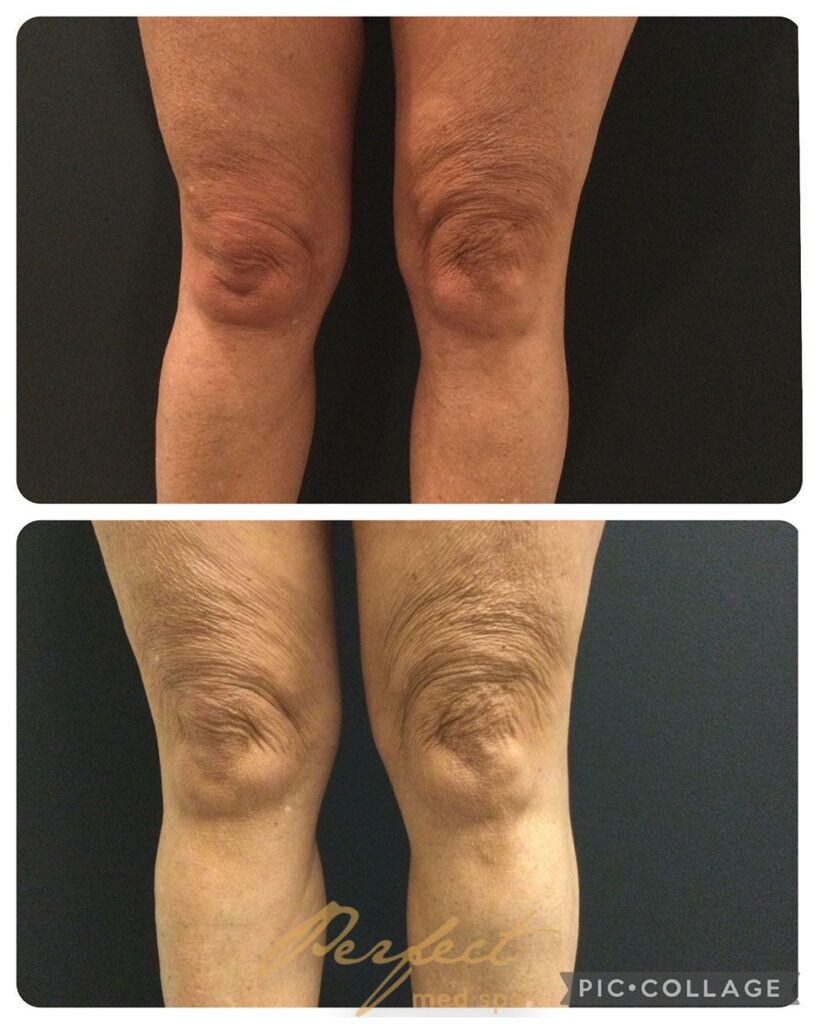 TightScupting Before and After Photo by Perfect Med SPA in New York New York