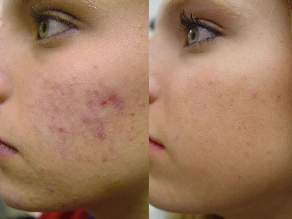 Acne Laser Before and After Photo by Perfect Med Spa in New York City, NY