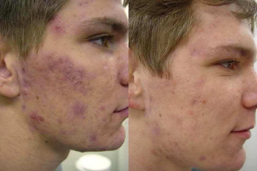 Acne Laser Before and After Photo by Perfect Med Spa in New York City, NY