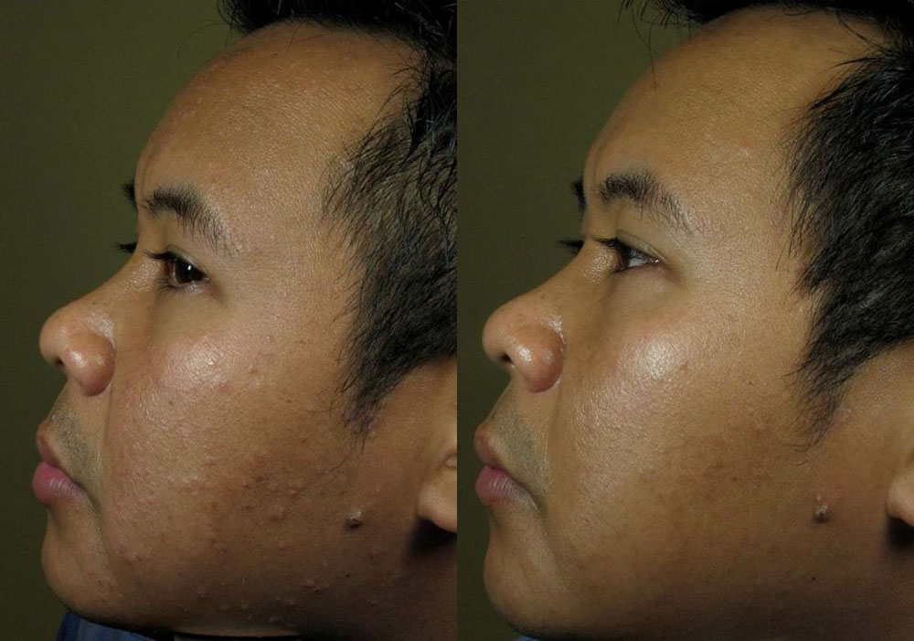 Acne Laser Before and After Photo by Perfect Med Spa in New York City, NY