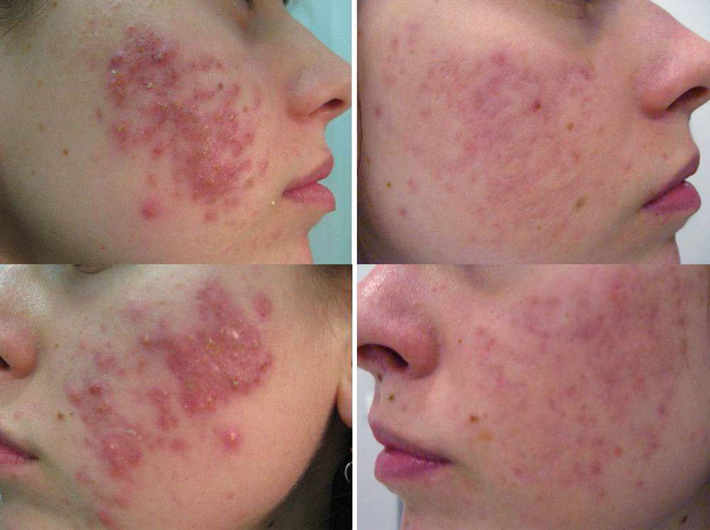 Acne Laser Before and After Photo by Perfect Med Spa in New York City, NY