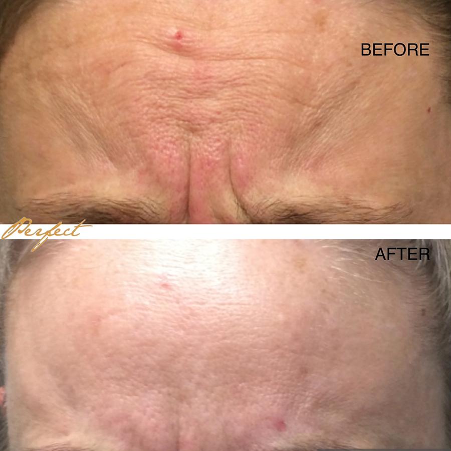 Botox, Dysport Facelift Before and After Photo by Perfect Med Spa in New York City, NY