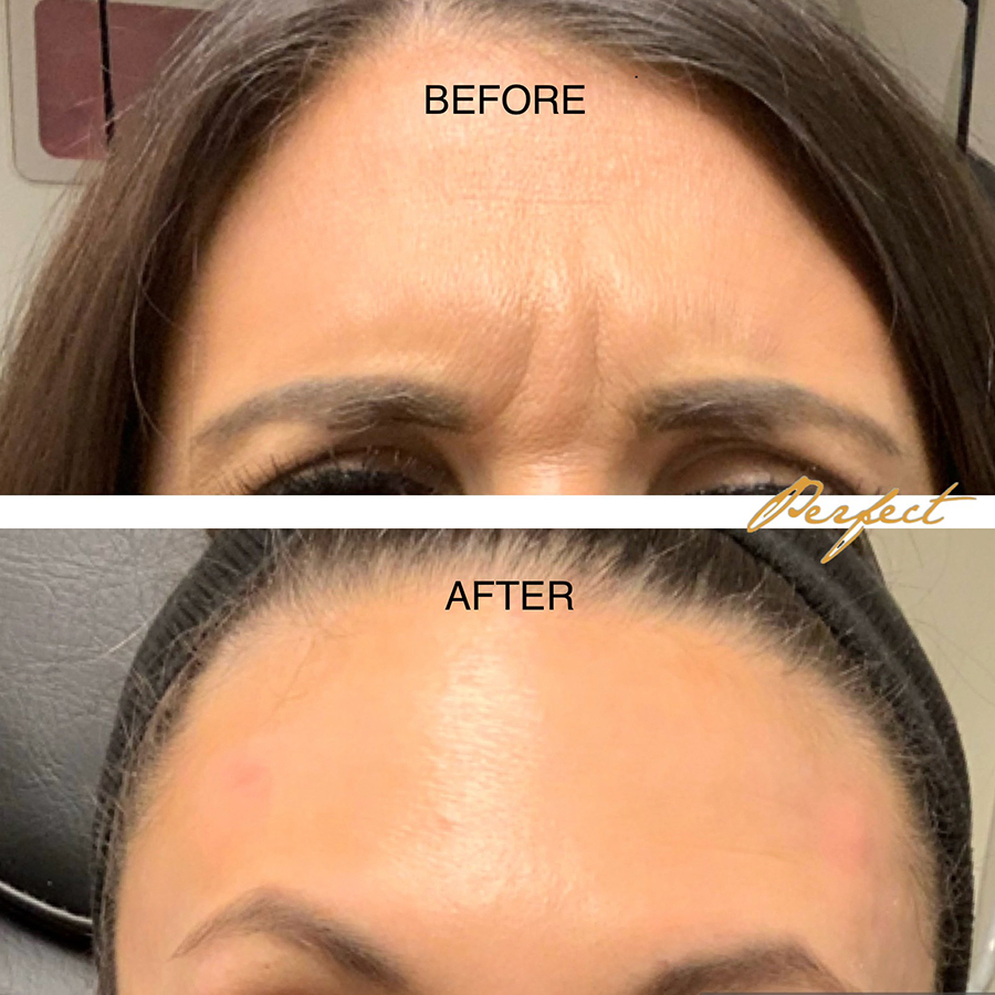 Botox, Dysport Facelift Before and After Photo by Perfect Med Spa in New York City, NY