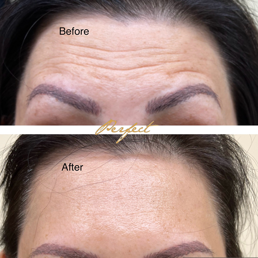 Botox, Dysport Facelift Before and After Photo by Perfect Med Spa in New York City, NY