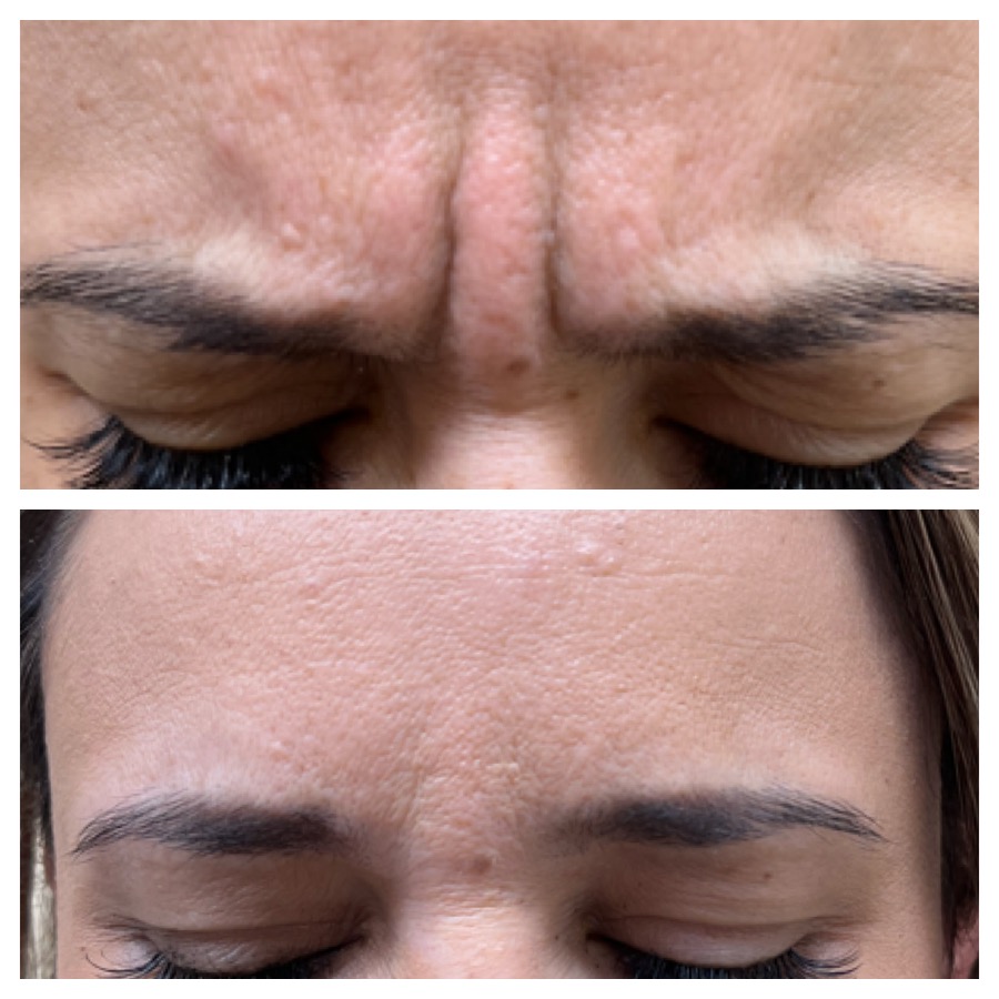 Botox, Dysport Facelift Before and After Photo by Perfect Med Spa in New York City, NY