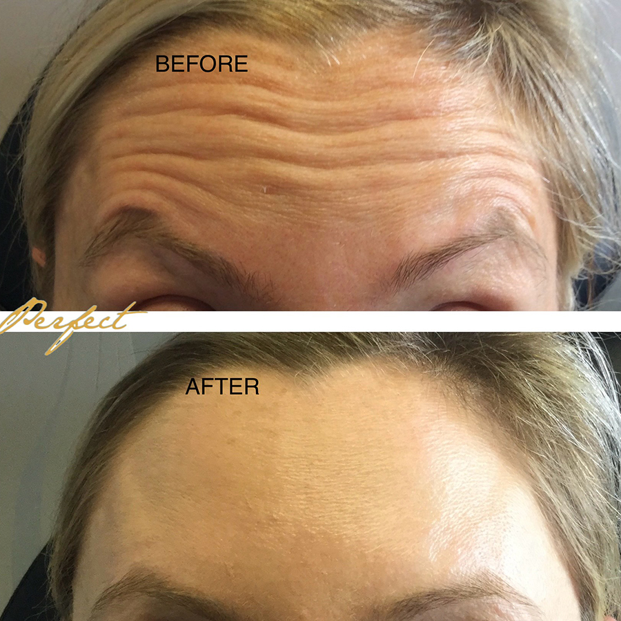 Botox, Dysport Facelift Before and After Photo by Perfect Med Spa in New York City, NY