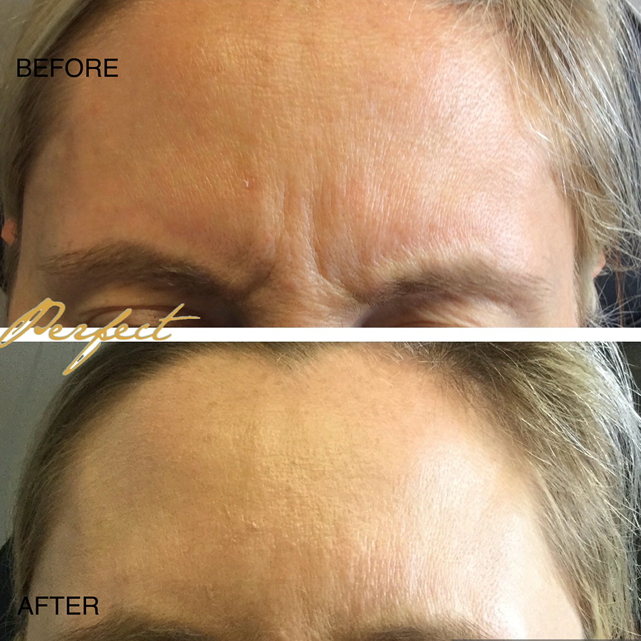 Botox, Dysport Facelift Before and After Photo by Perfect Med Spa in New York City, NY