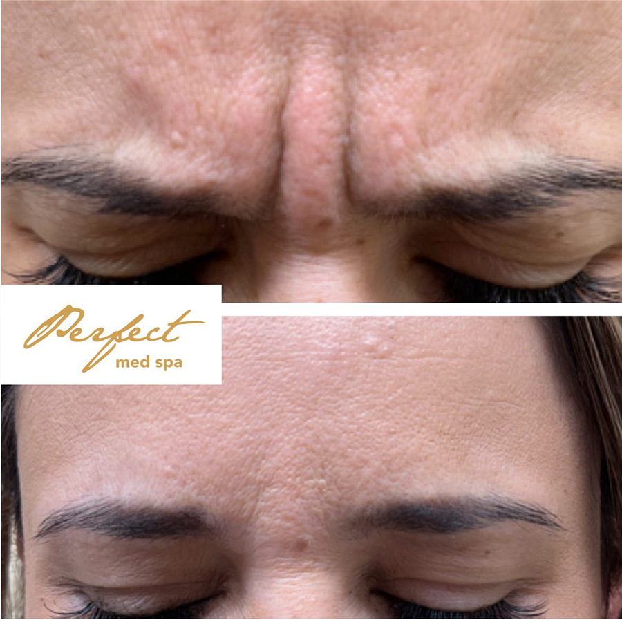 Botox, Dysport Facelift Before and After Photo by Perfect Med Spa in New York City, NY