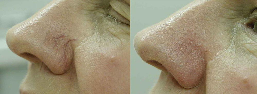 Broken Capillaries, Rosacea Before and After Photo by Perfect Med Spa in New York City, NY