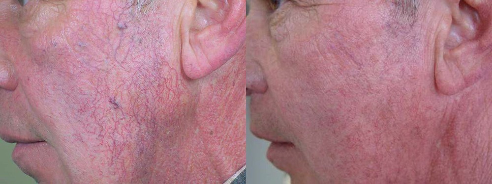 Broken Capillaries, Rosacea Before and After Photo by Perfect Med Spa in New York City, NY