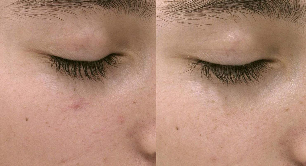 Broken Capillaries, Rosacea Before and After Photo by Perfect Med Spa in New York City, NY