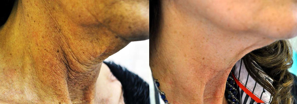 Fotona D Facelift Before and After Photo by Perfect Med Spa in New York City, NY