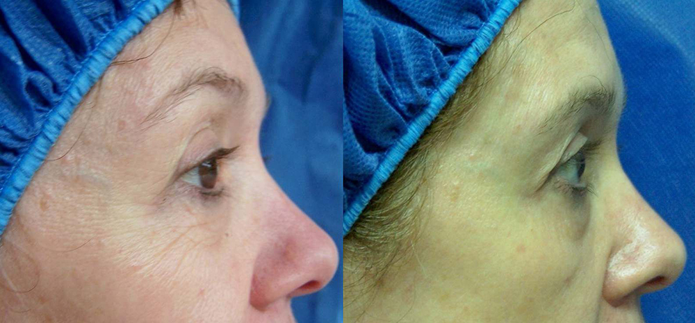 Fotona D Facelift Before and After Photo by Perfect Med Spa in New York City, NY