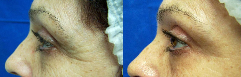 Fotona D Facelift Before and After Photo by Perfect Med Spa in New York City, NY