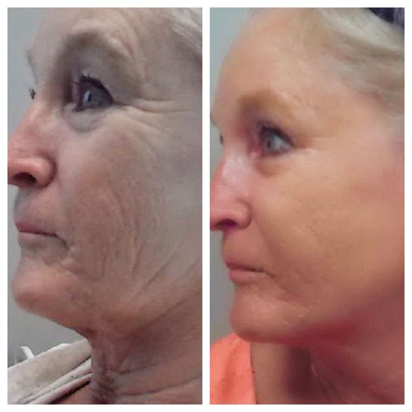 Fotona D Facelift Before and After Photo by Perfect Med Spa in New York City, NY