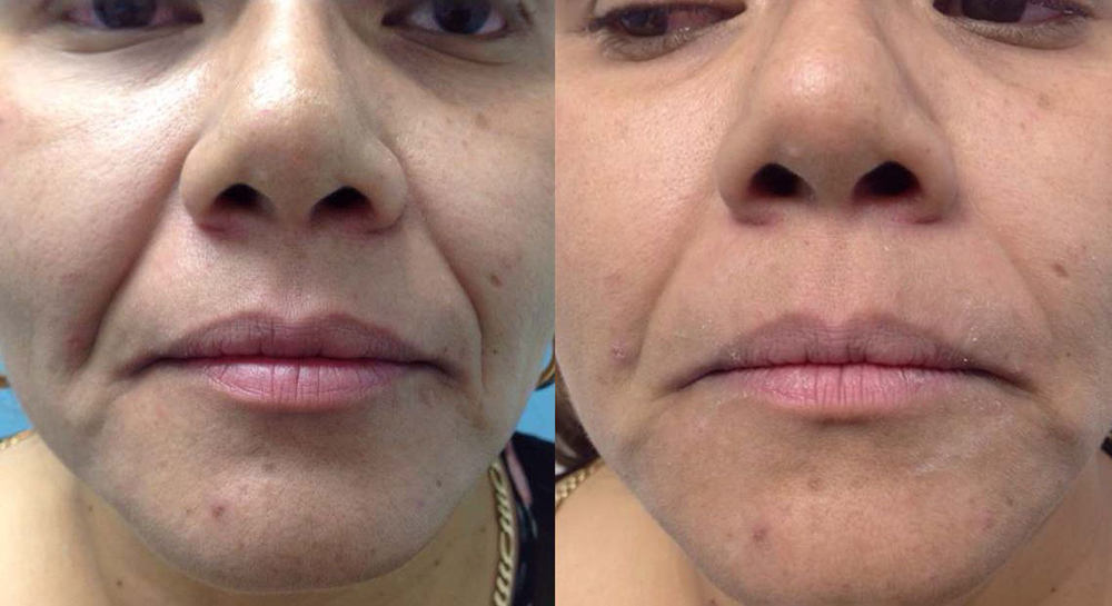 Fotona D Facelift Before and After Photo by Perfect Med Spa in New York City, NY