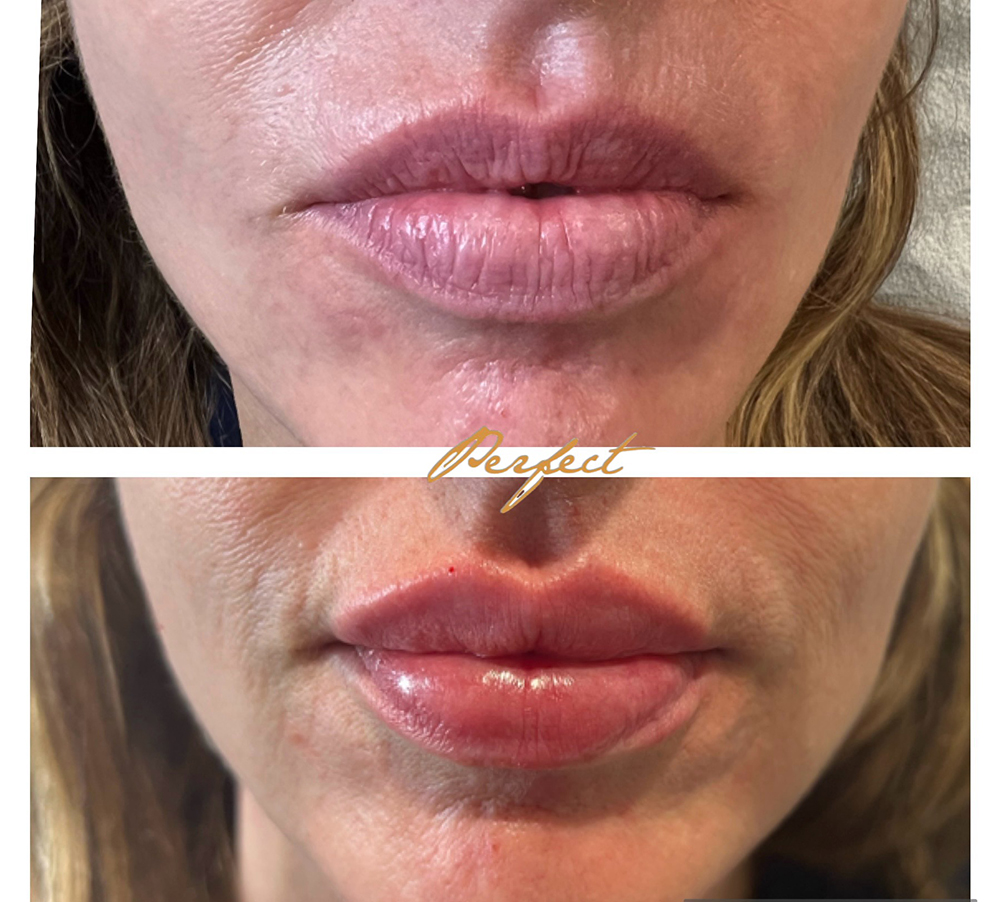 Lip Injections Facelift Before and After Photo by Perfect Med Spa in New York City, NY
