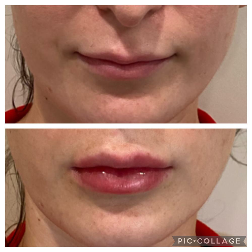 Lip Injections Facelift Before and After Photo by Perfect Med Spa in New York City, NY