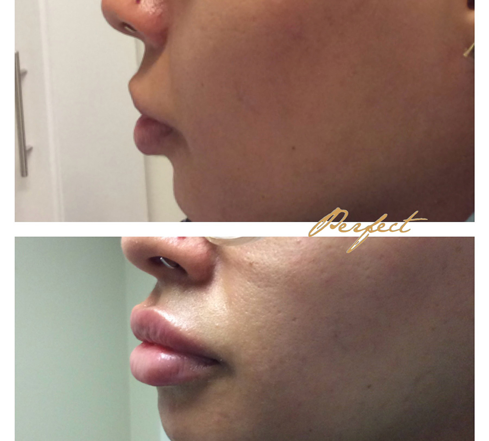 Lip Injections Facelift Before and After Photo by Perfect Med Spa in New York City, NY
