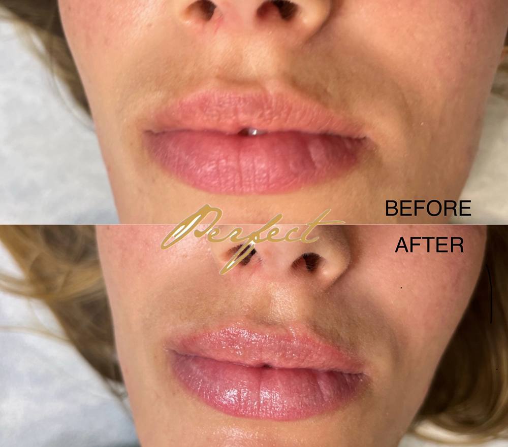 LipLase Facelift Before and After Photo by Perfect Med Spa in New York City, NY