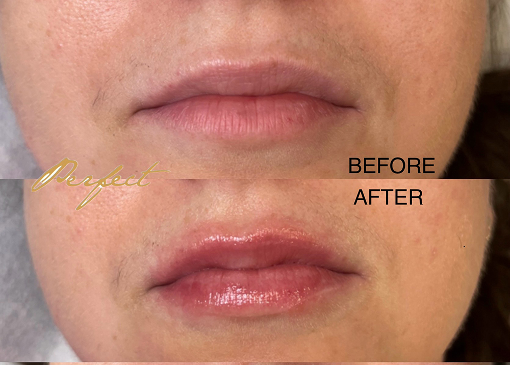 LipLase Facelift Before and After Photo by Perfect Med Spa in New York City, NY