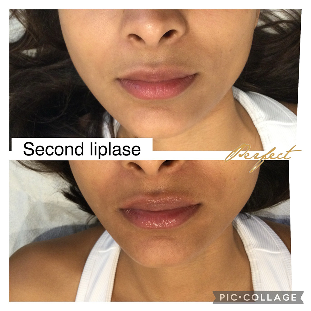 LipLase Facelift Before and After Photo by Perfect Med Spa in New York City, NY