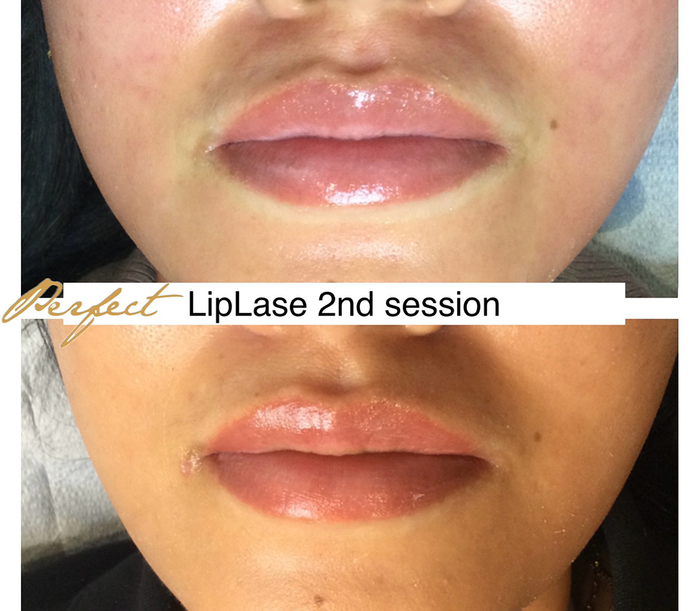LipLase Facelift Before and After Photo by Perfect Med Spa in New York City, NY