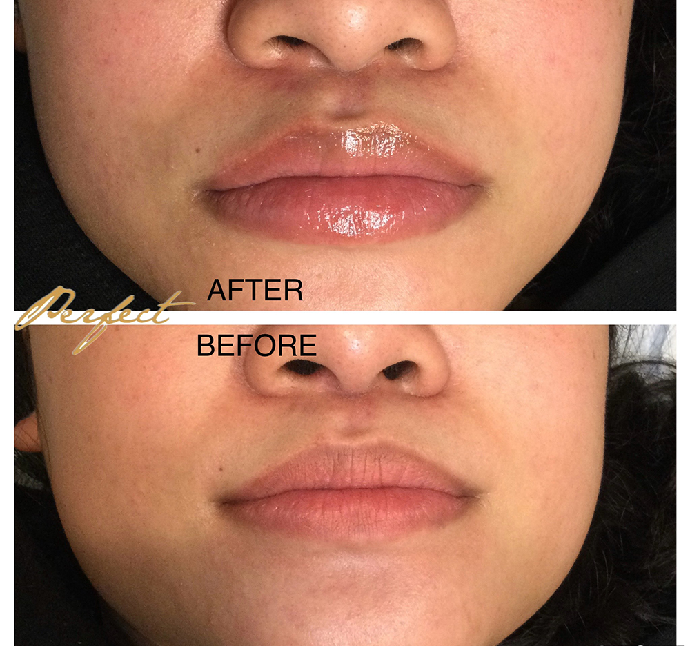 LipLase Facelift Before and After Photo by Perfect Med Spa in New York City, NY