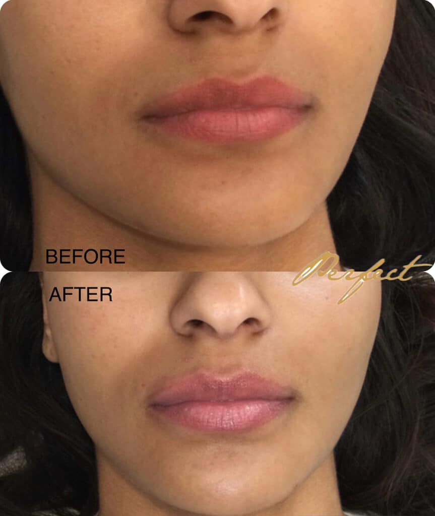 LipLase Facelift Before and After Photo by Perfect Med Spa in New York City, NY