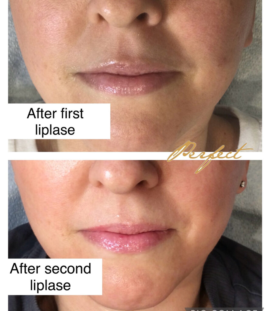 LipLase Facelift Before and After Photo by Perfect Med Spa in New York City, NY