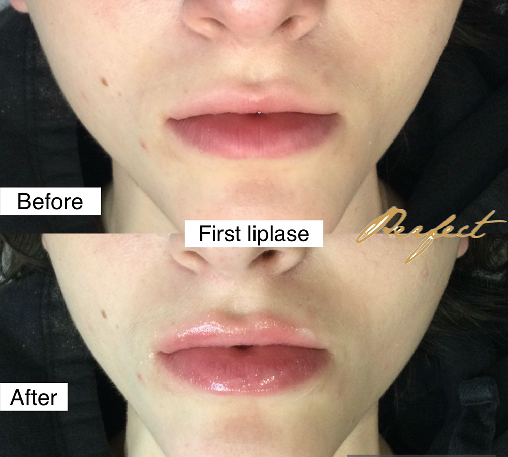 LipLase Facelift Before and After Photo by Perfect Med Spa in New York City, NY