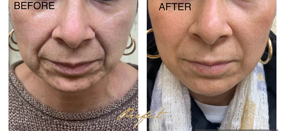 Nasolabial Folds Filler Before and After Photo by Perfect Med Spa in New York City, NY