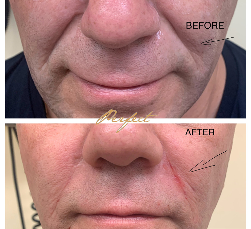 Nasolabial Folds Filler Before and After Photo by Perfect Med Spa in New York City, NY
