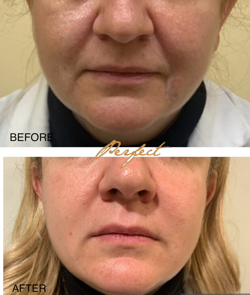 Nasolabial Folds Filler Before and After Photo by Perfect Med Spa in New York City, NY