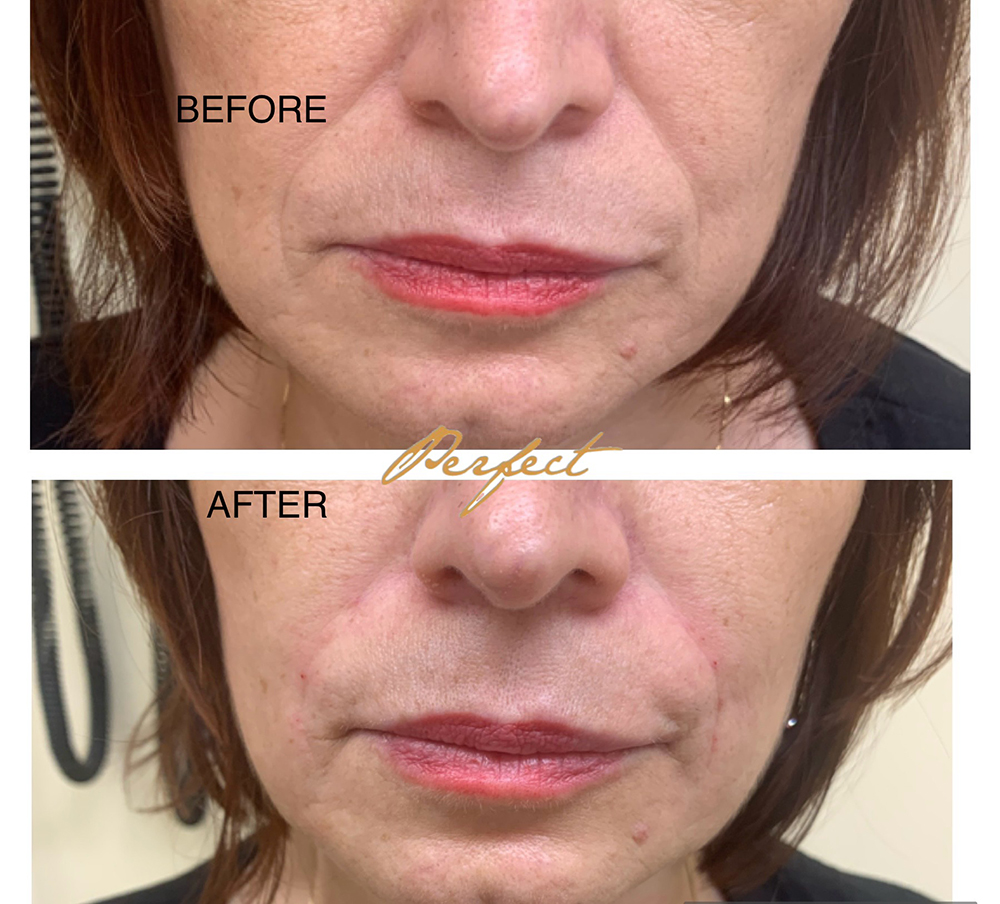 Nasolabial Folds Filler Before and After Photo by Perfect Med Spa in New York City, NY