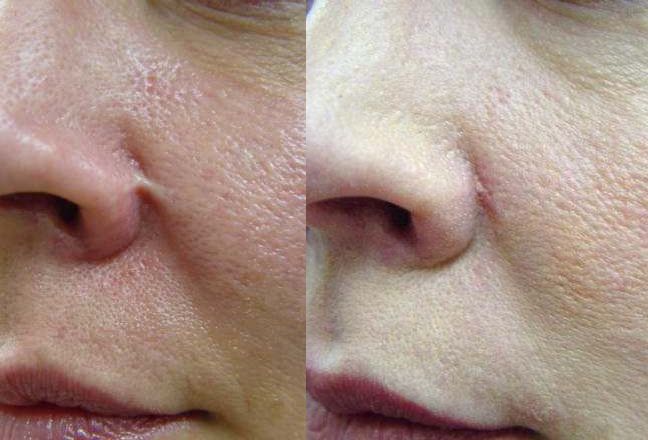 Scars, Stretch Marks Facelift Before and After Photo by Perfect Med Spa in New York City, NY