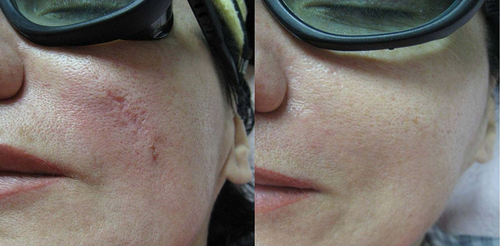 Scars, Stretch Marks Facelift Before and After Photo by Perfect Med Spa in New York City, NY