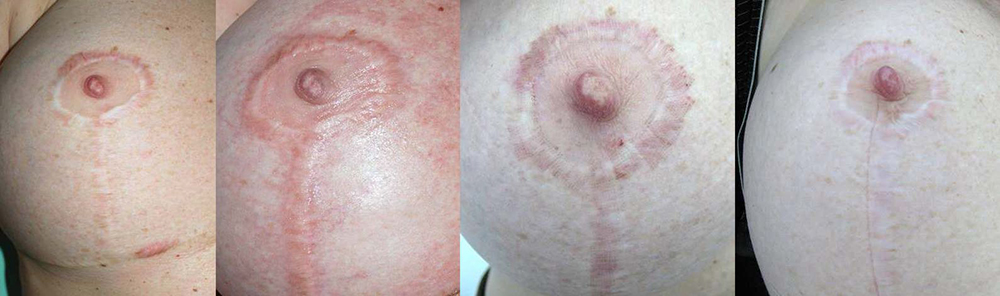 Scars, Stretch Marks Facelift Before and After Photo by Perfect Med Spa in New York City, NY